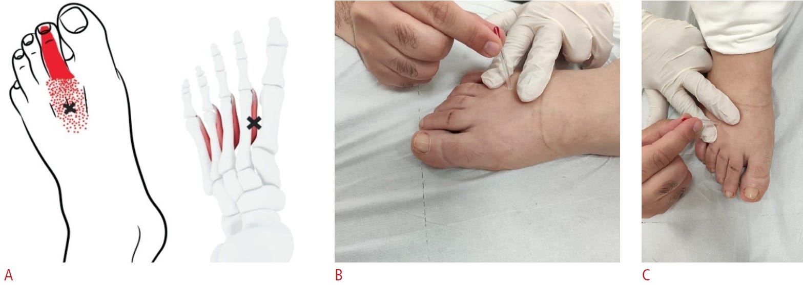 Musculos interoseos tempo formacion 1.jpg
